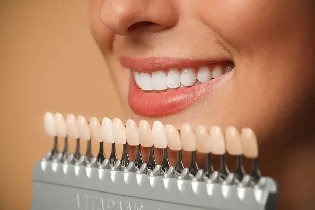 Sorriso perfetto con trattamenti di estetica dentale — Carpi Dental Service